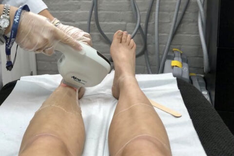 Laser Hair Removal