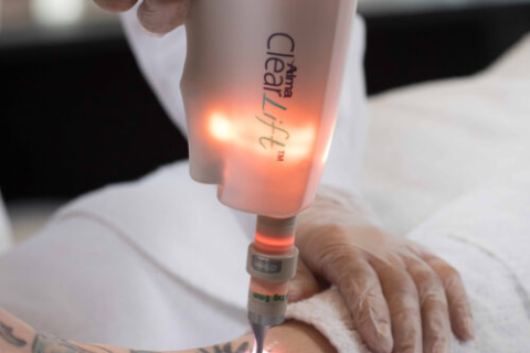 Laser Tattoo Removal