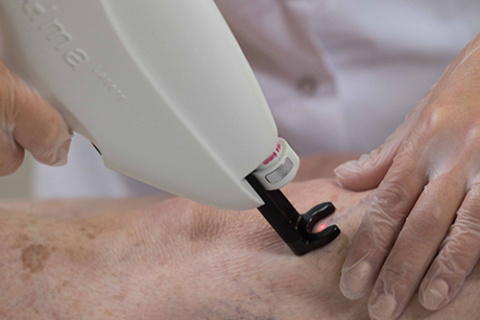 Laser Removal